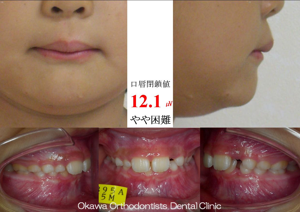 249. ７年にわたる治療の Before 画像
