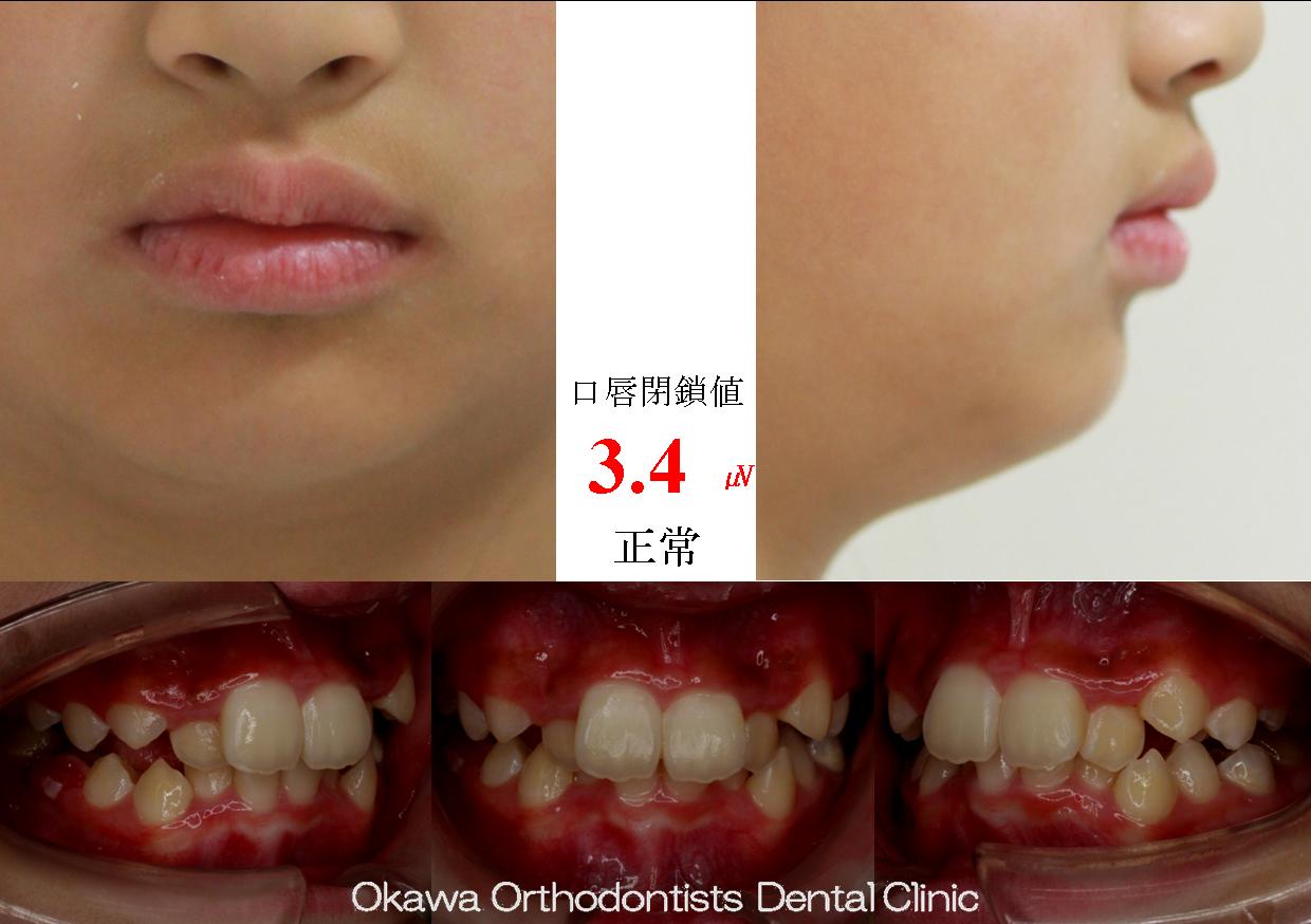 257. 著しい叢生の Before 画像
