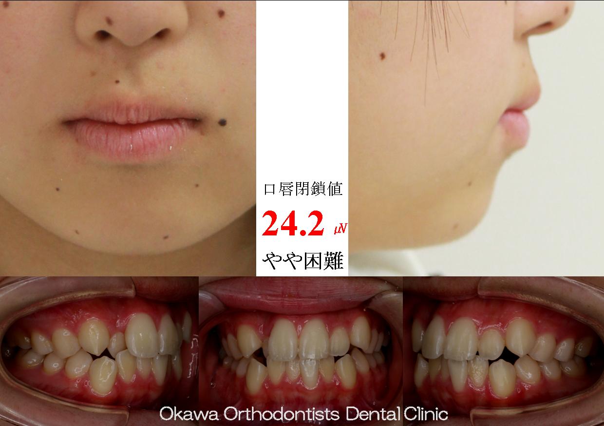 255. 短期留学が迫り早期に仕上げの Before 画像
