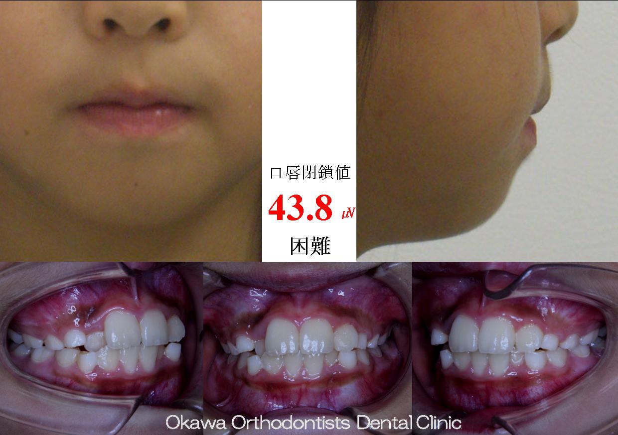 282. 叢生、右側の側切歯クロスバイトの Before 画像