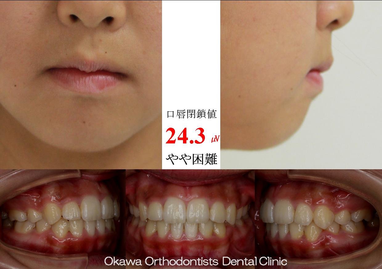 282. 叢生、右側の側切歯クロスバイトの After 画像