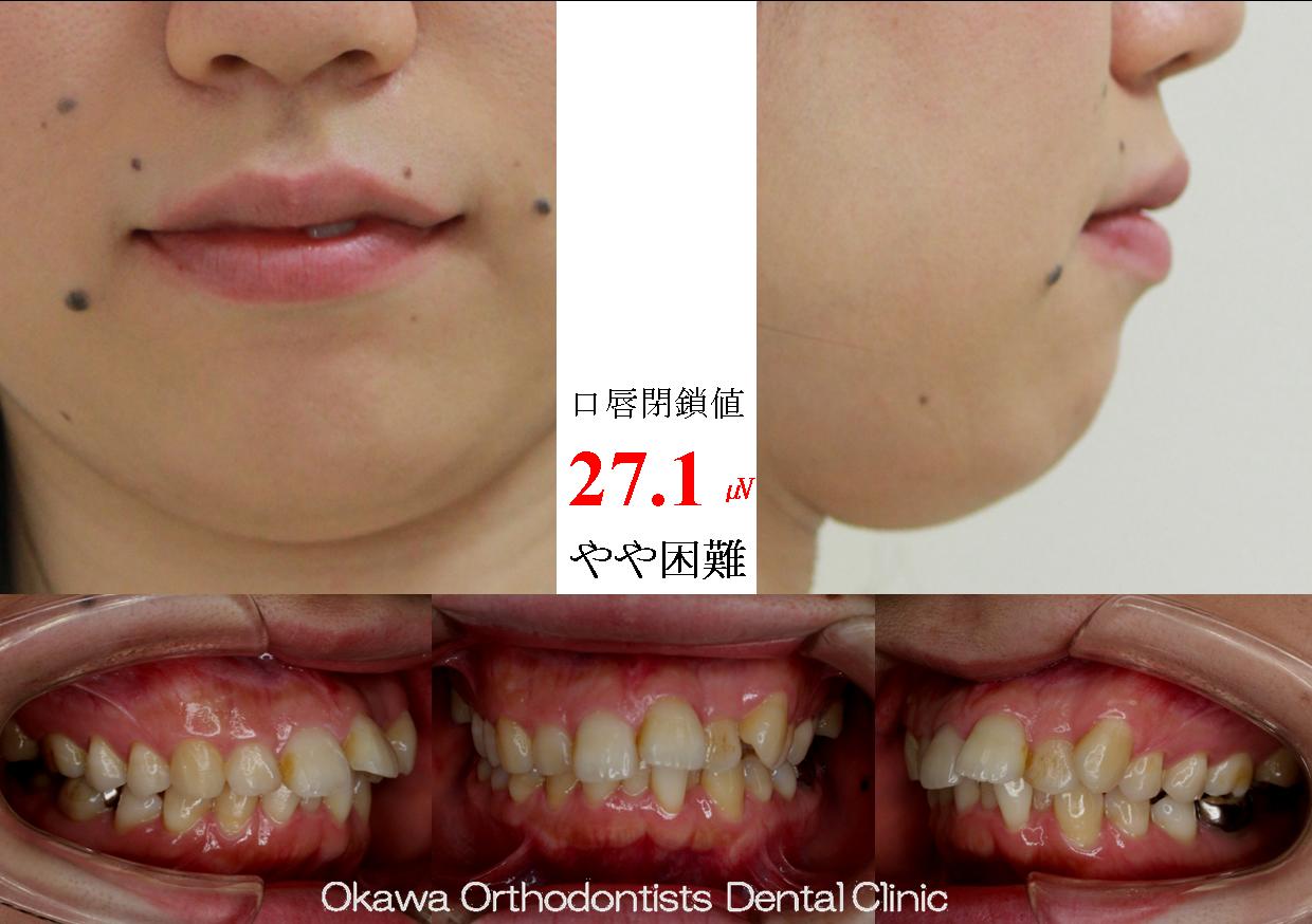 278. 叢生、上顎前突、口唇閉鎖不全の Before 画像