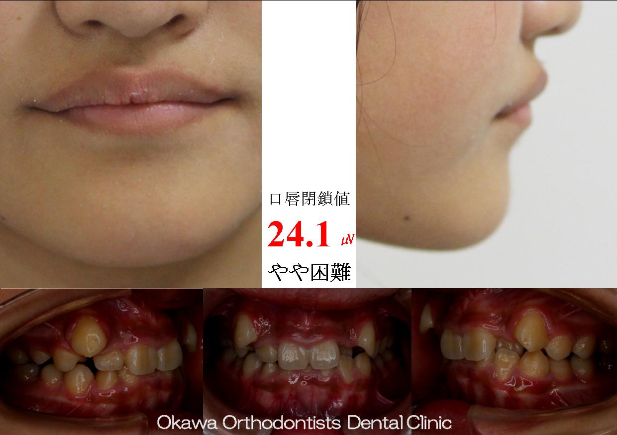 292. 第二小臼歯抜歯の Before 画像