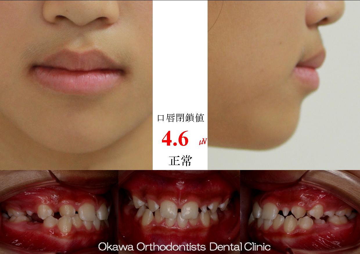 295. 先天欠如、矮小歯の Before 画像