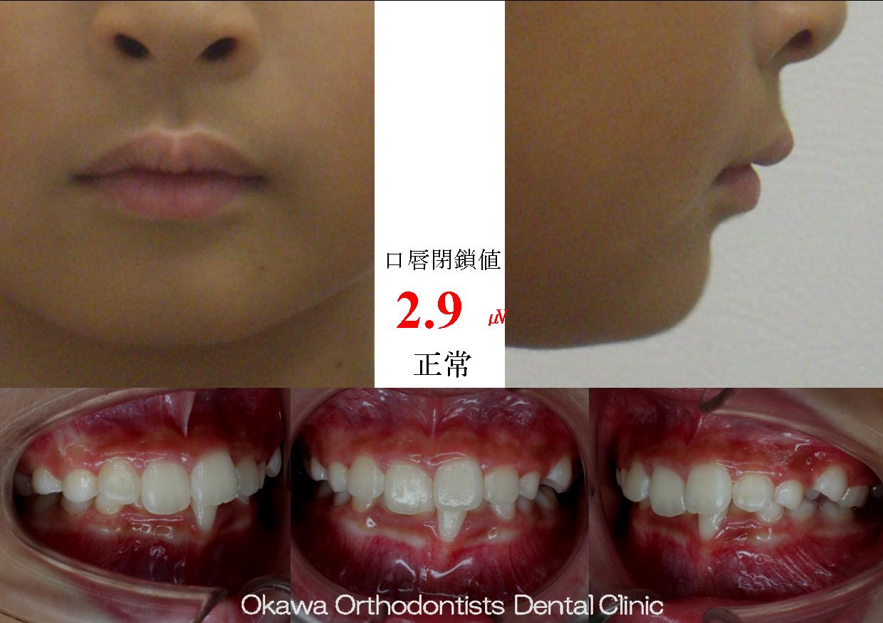 303. 過蓋咬合の Before 画像