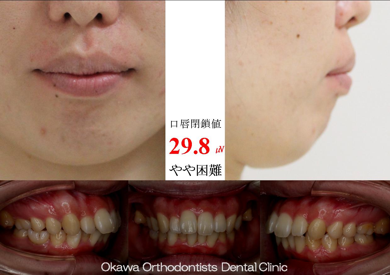 300. 両側第二大臼歯が鋏状咬合の Before 画像