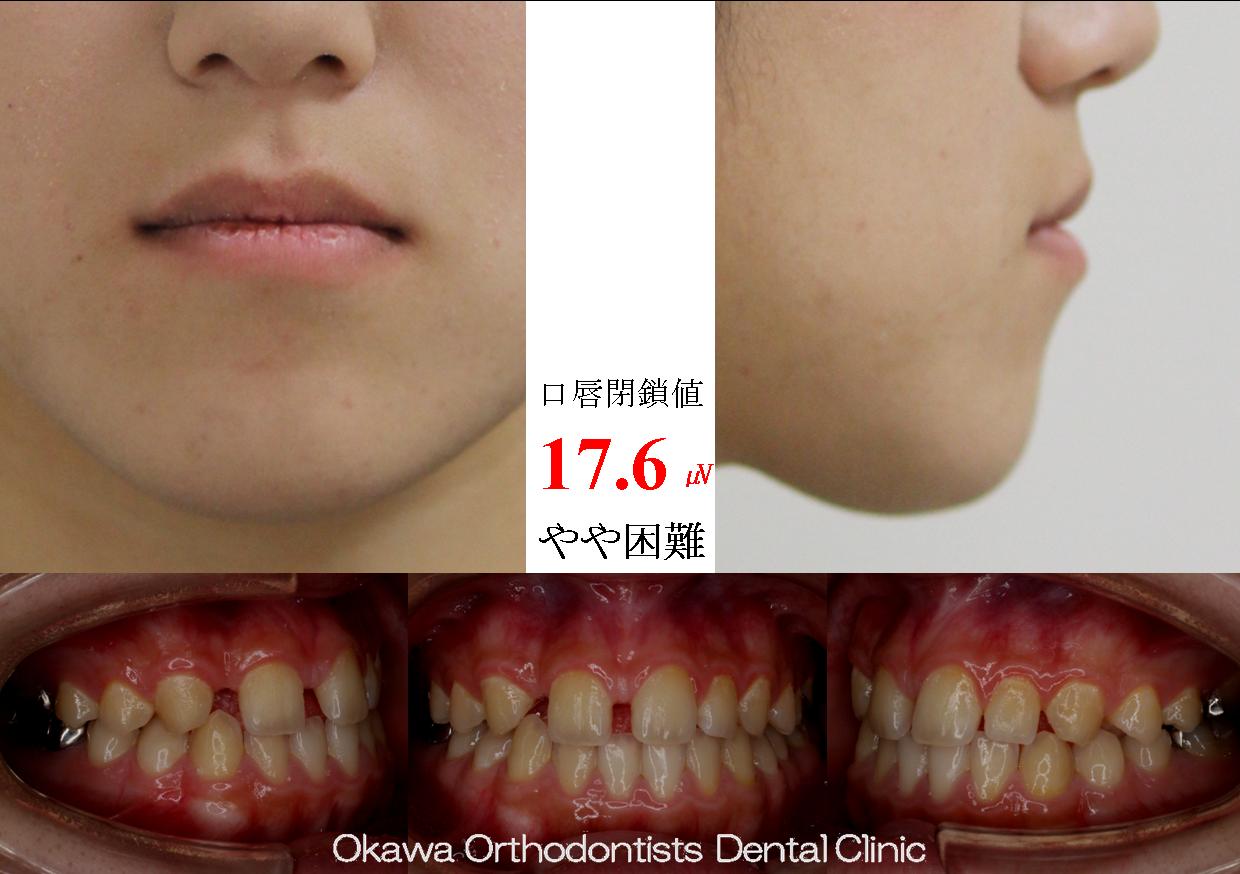 311. 側切歯の先天欠如で正中離開の Before 画像