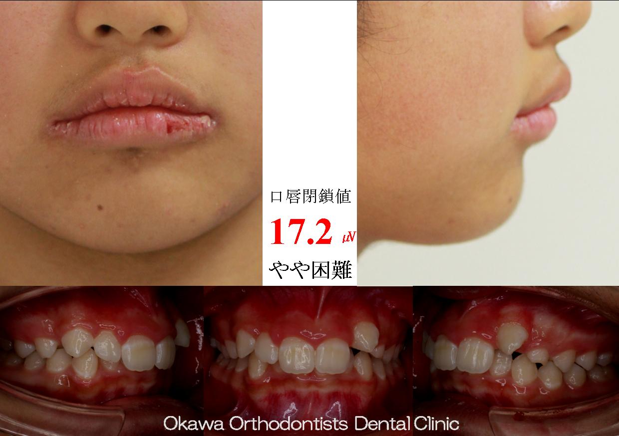 319. 左上側切歯の先天欠如の Before 画像