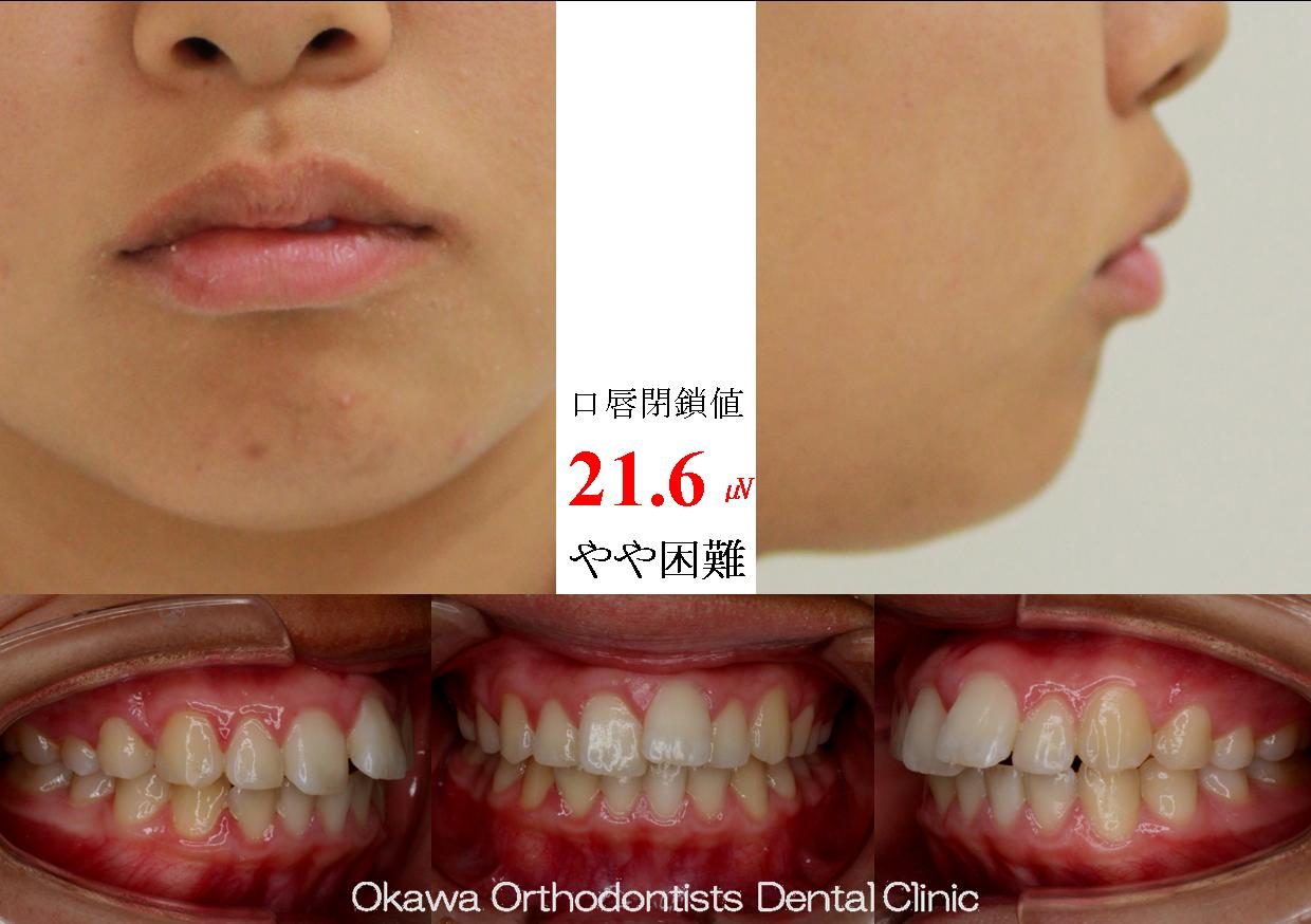 332. 意外に長かった治療期間の Before 画像