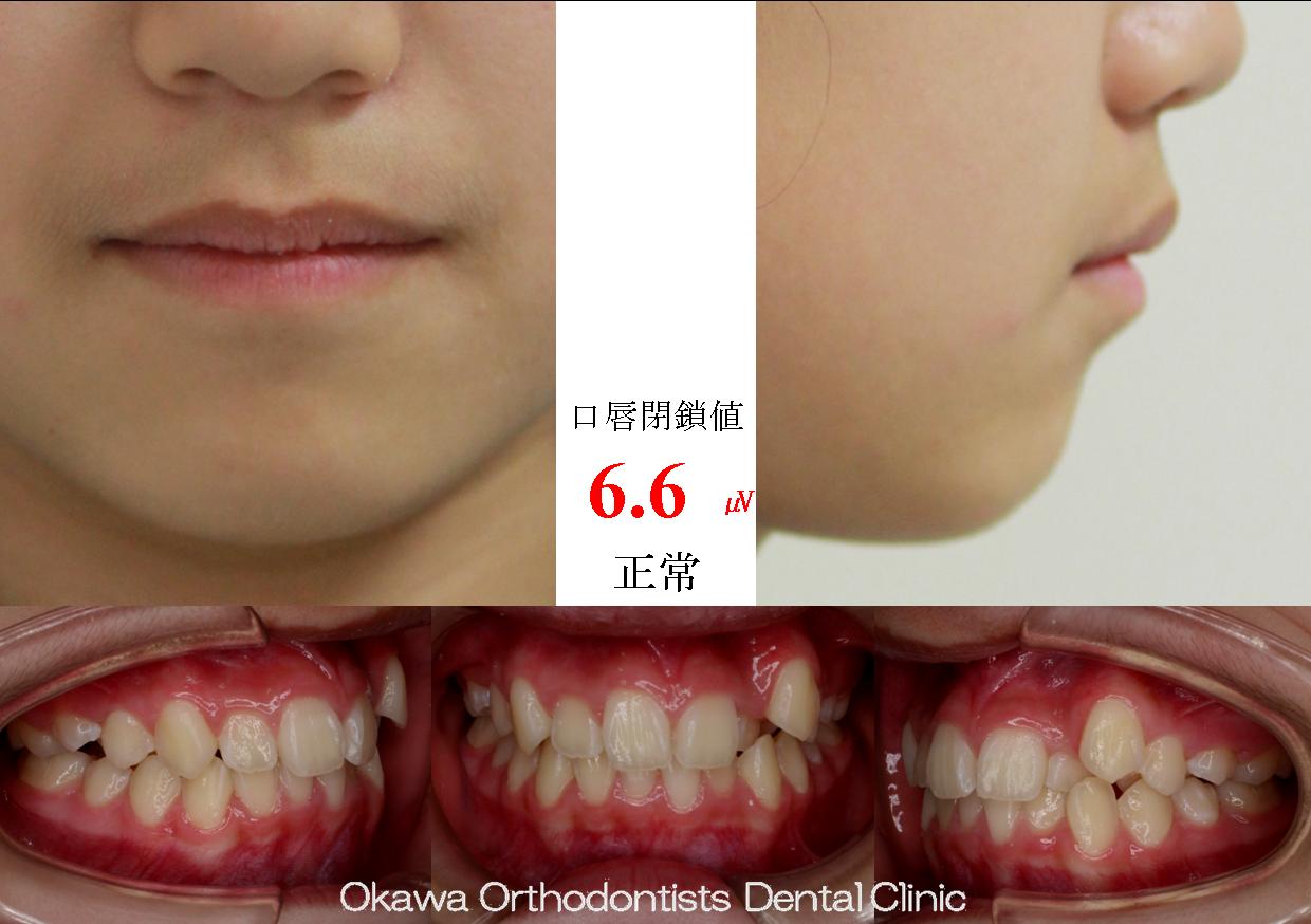 342. 比較的簡単な叢生の Before 画像