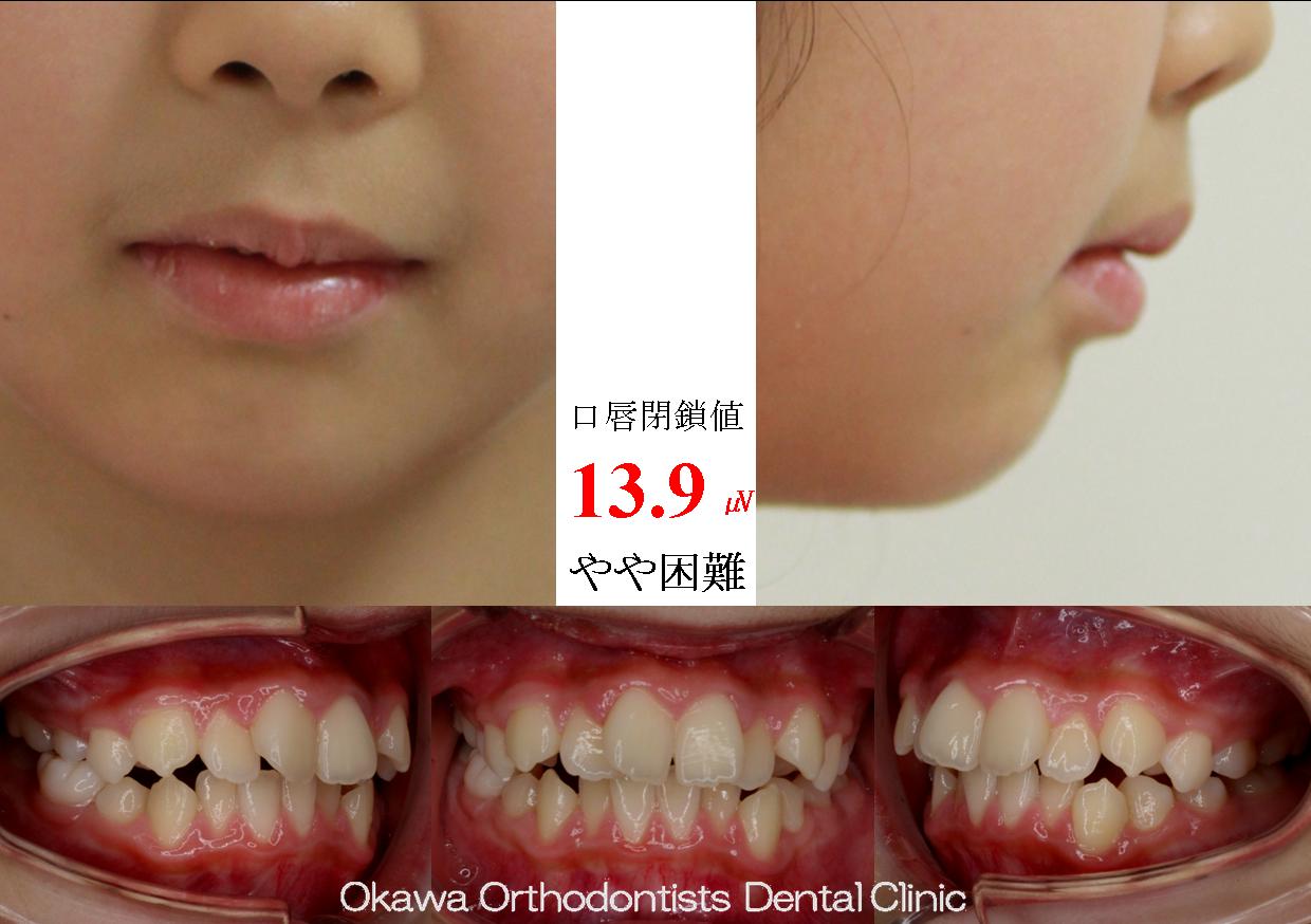 385. 健康保険適用の矯正治療の Before 画像