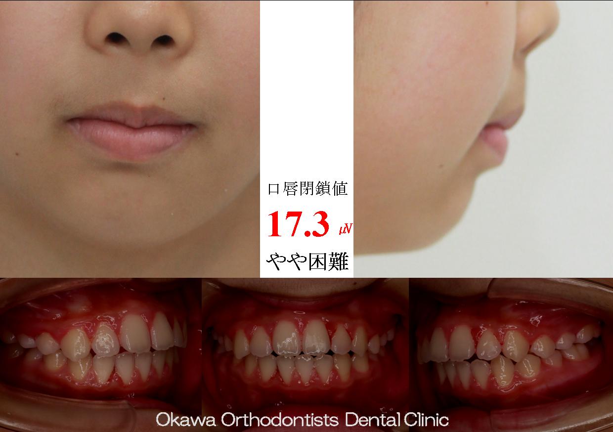 385. 健康保険適用の矯正治療の After 画像