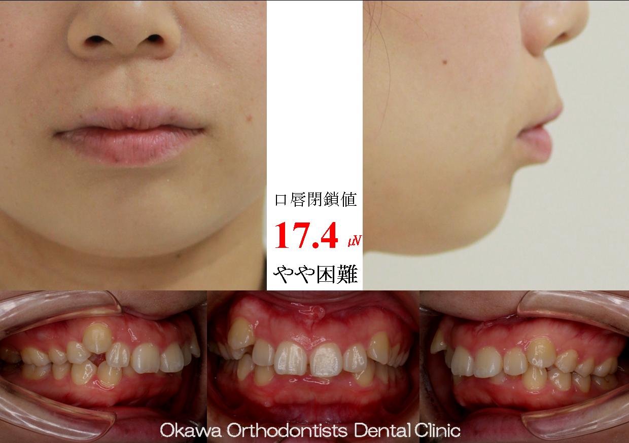 392. 叢生、上顎前突、左上７欠損の Before 画像