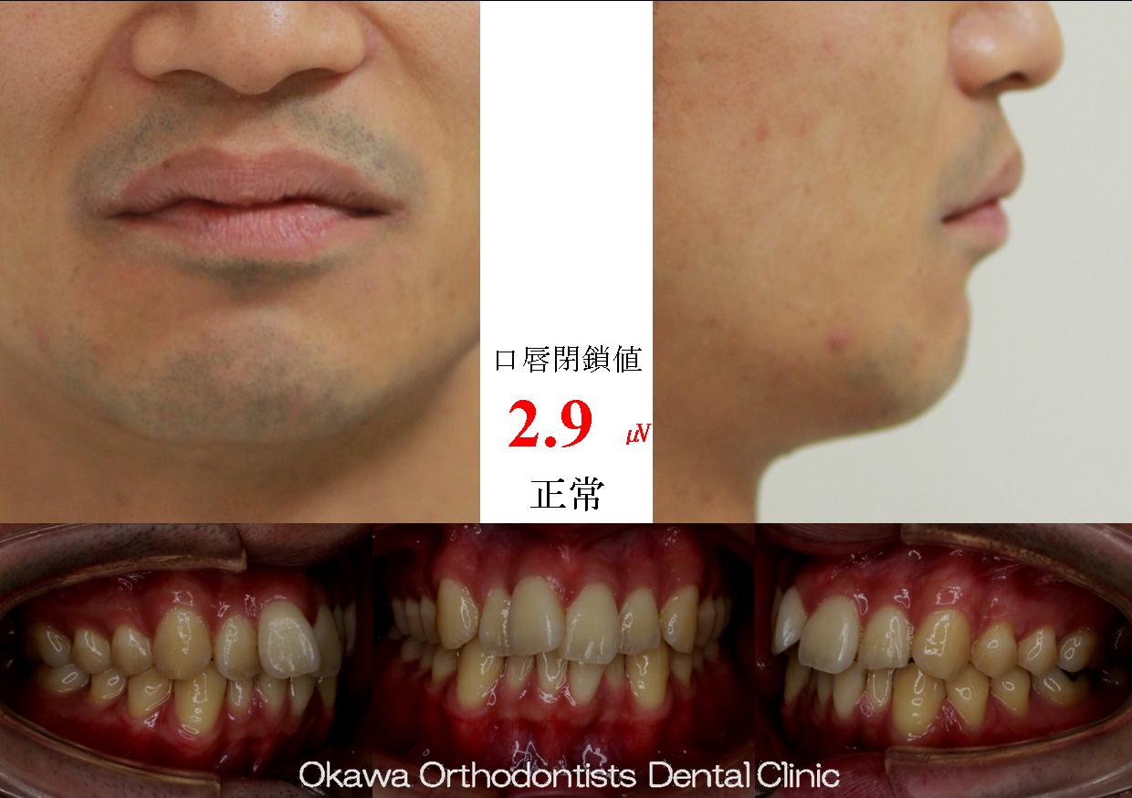 395. とても治療期間が長くなってしまったの Before 画像