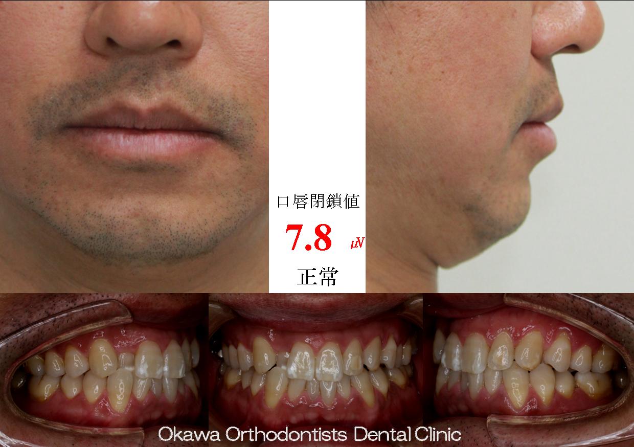 408. 中年男性の軽度叢生の Before 画像