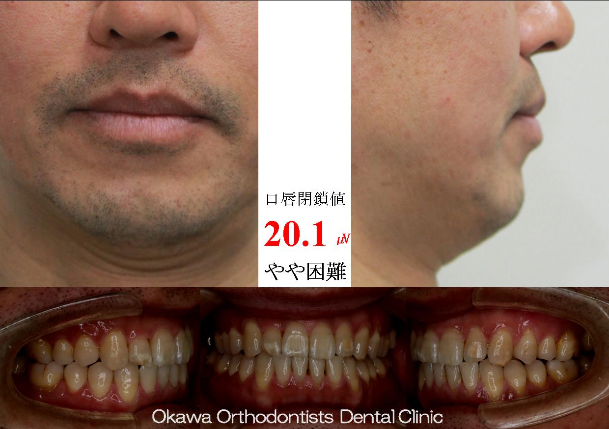 408. 中年男性の軽度叢生の After 画像