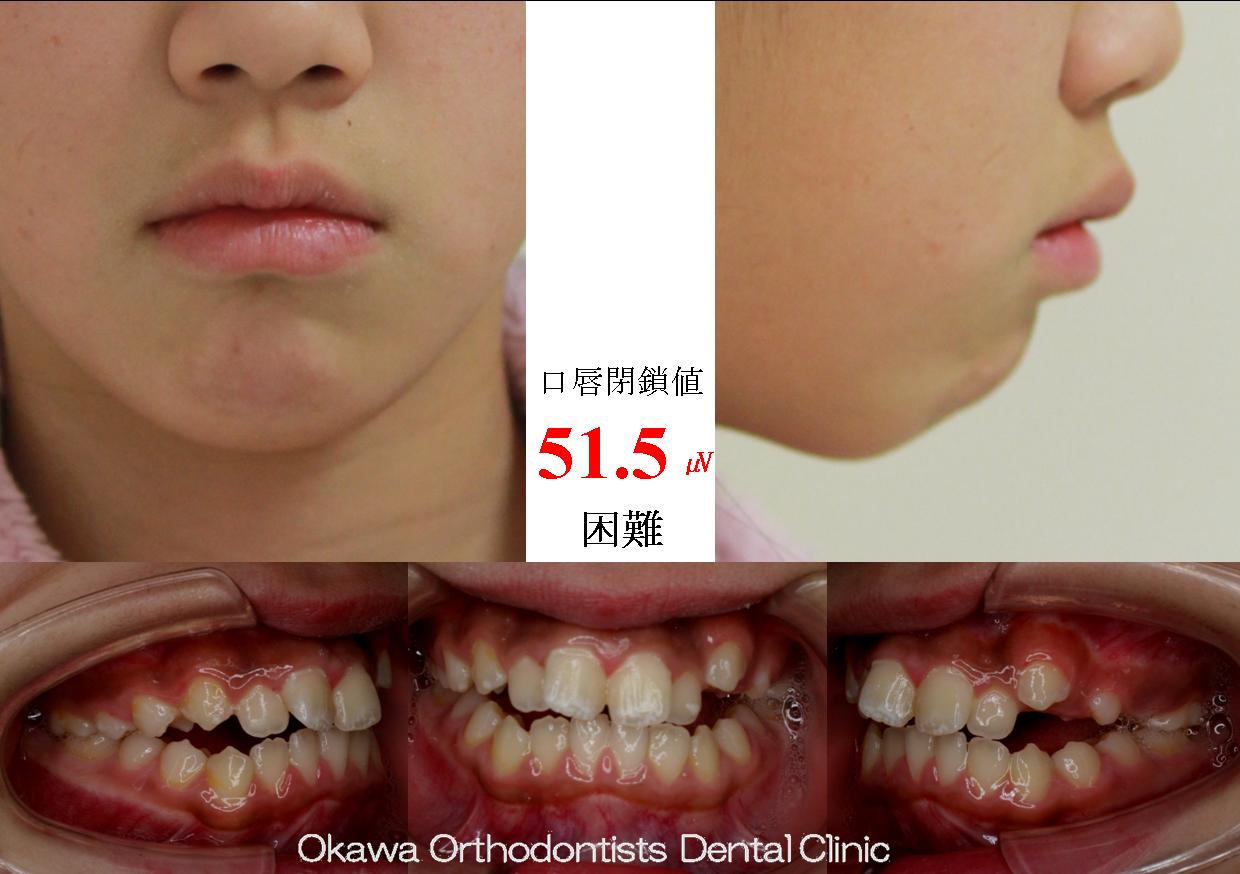 415. 叢生、咬合の Before 画像