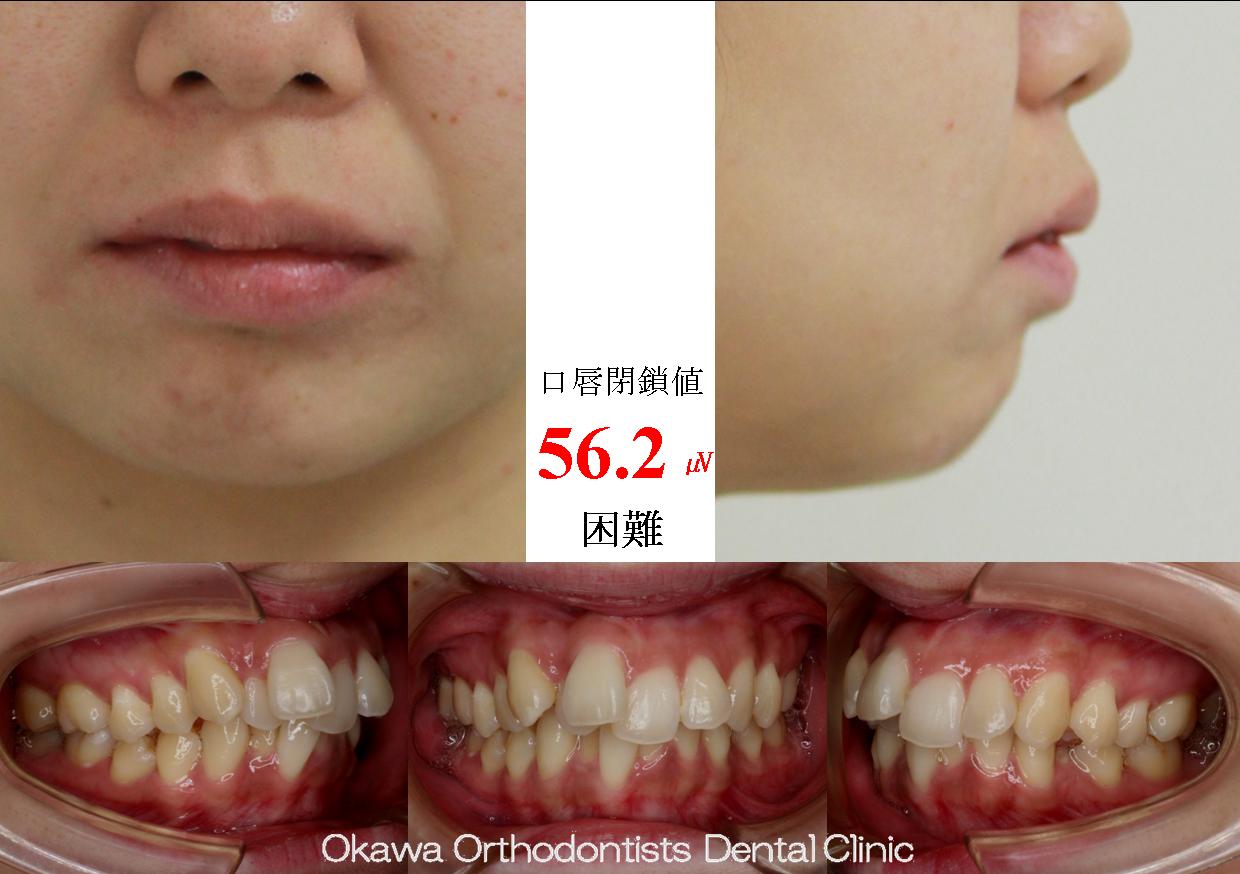 432. 上顎前歯に目立つ叢生の Before 画像