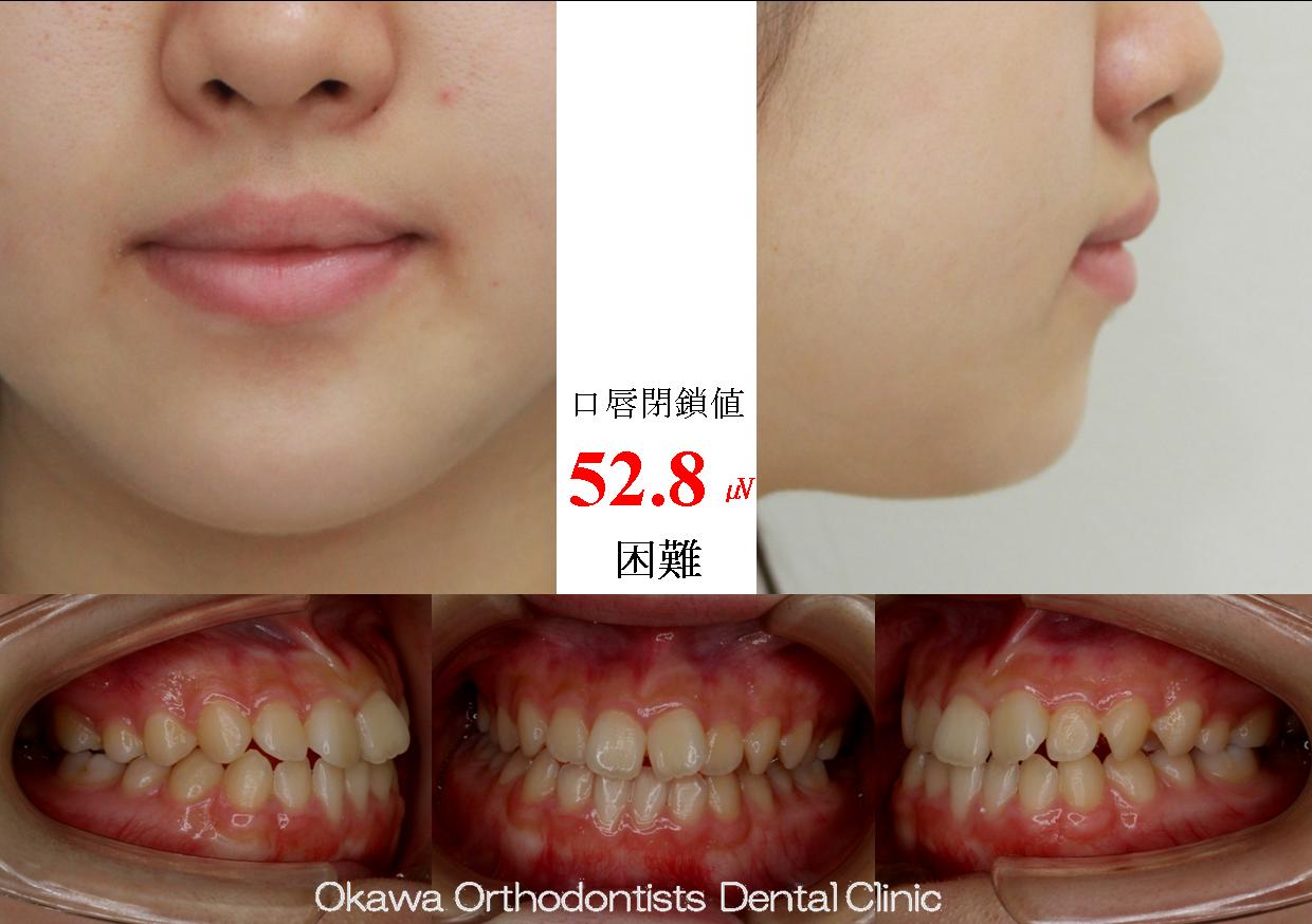 442. 軽度な叢生を非抜歯での Before 画像