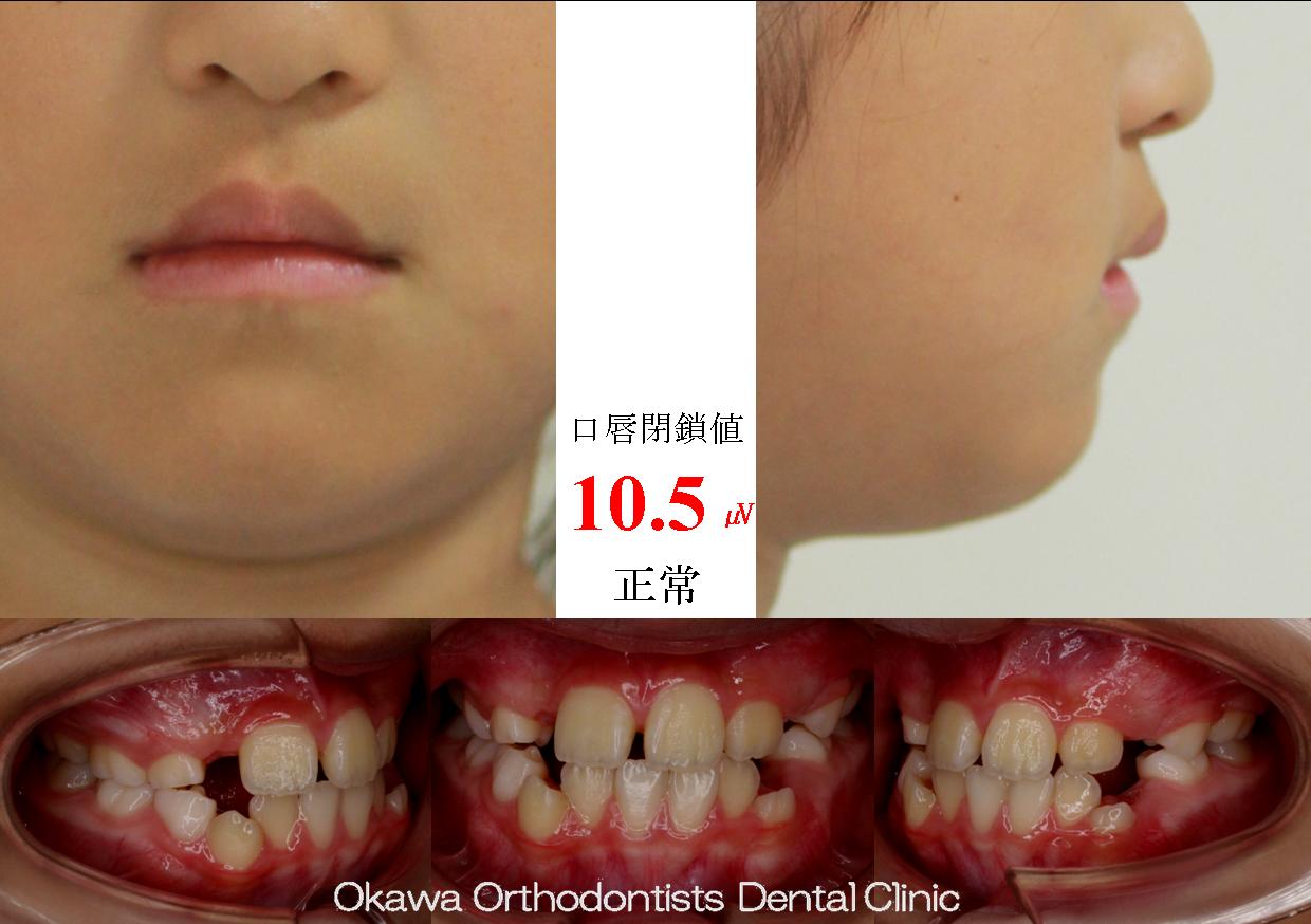 445. 埋伏歯　先天欠如歯の Before 画像
