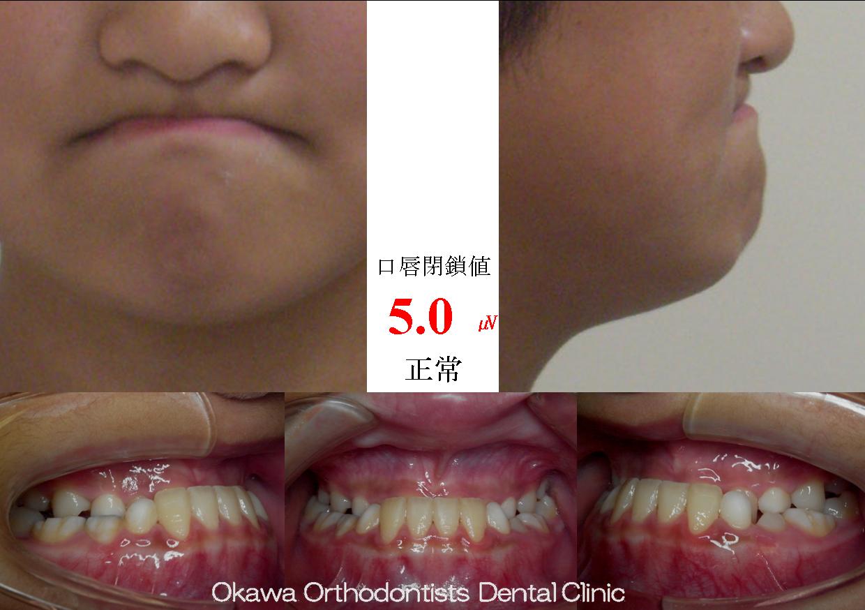 450. 顎変形症と7歯先天欠如の Before 画像