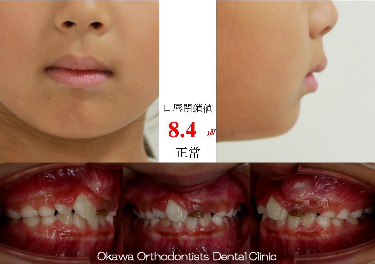 451.左上の埋伏歯の Before 画像