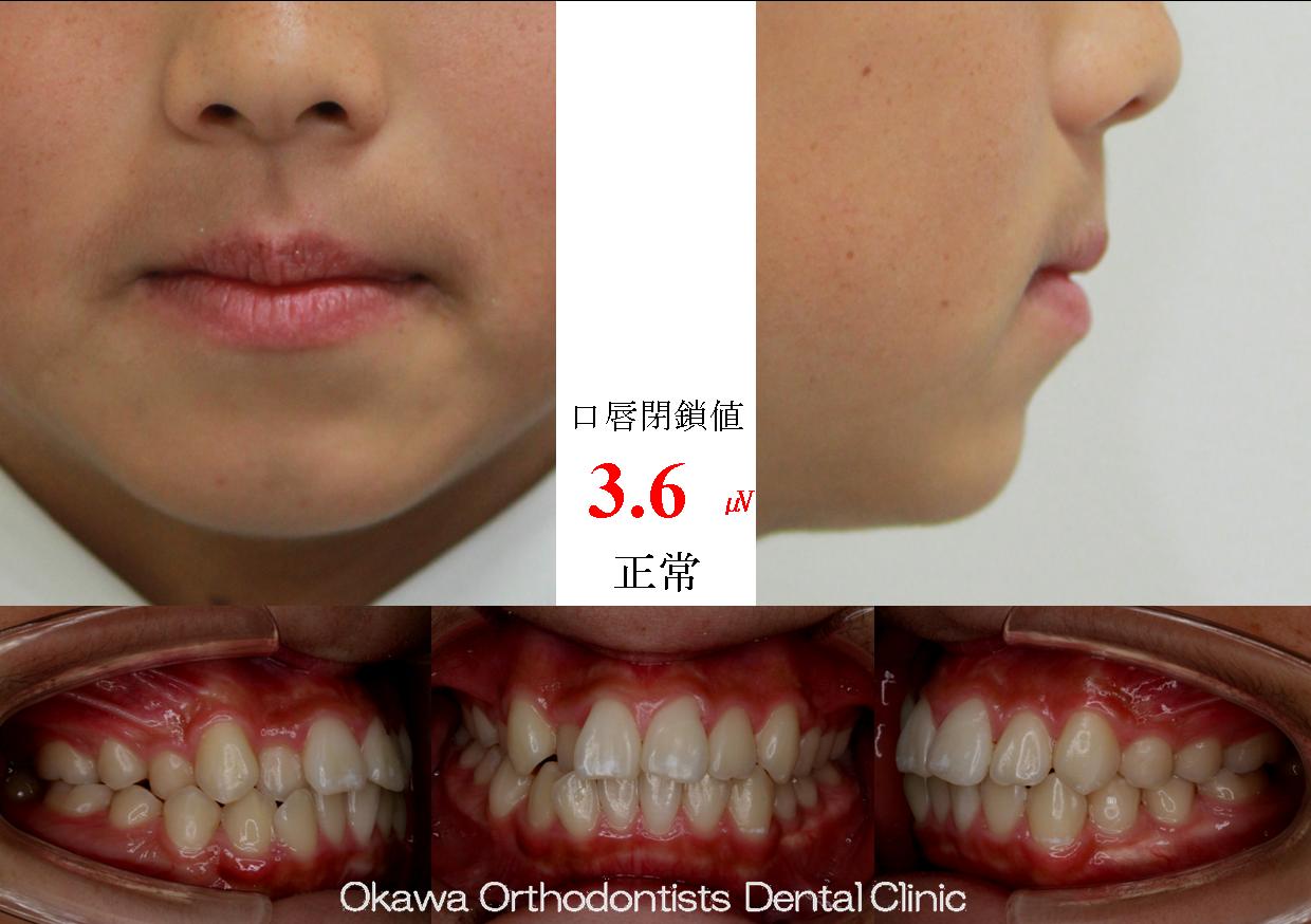 455. 短期治療期間の抜歯ケースの Before 画像
