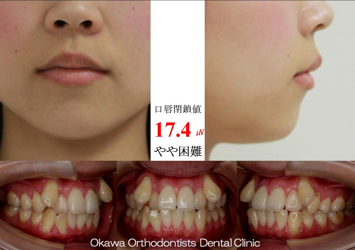 465. 下顎小臼歯抜歯を追加の Before 画像