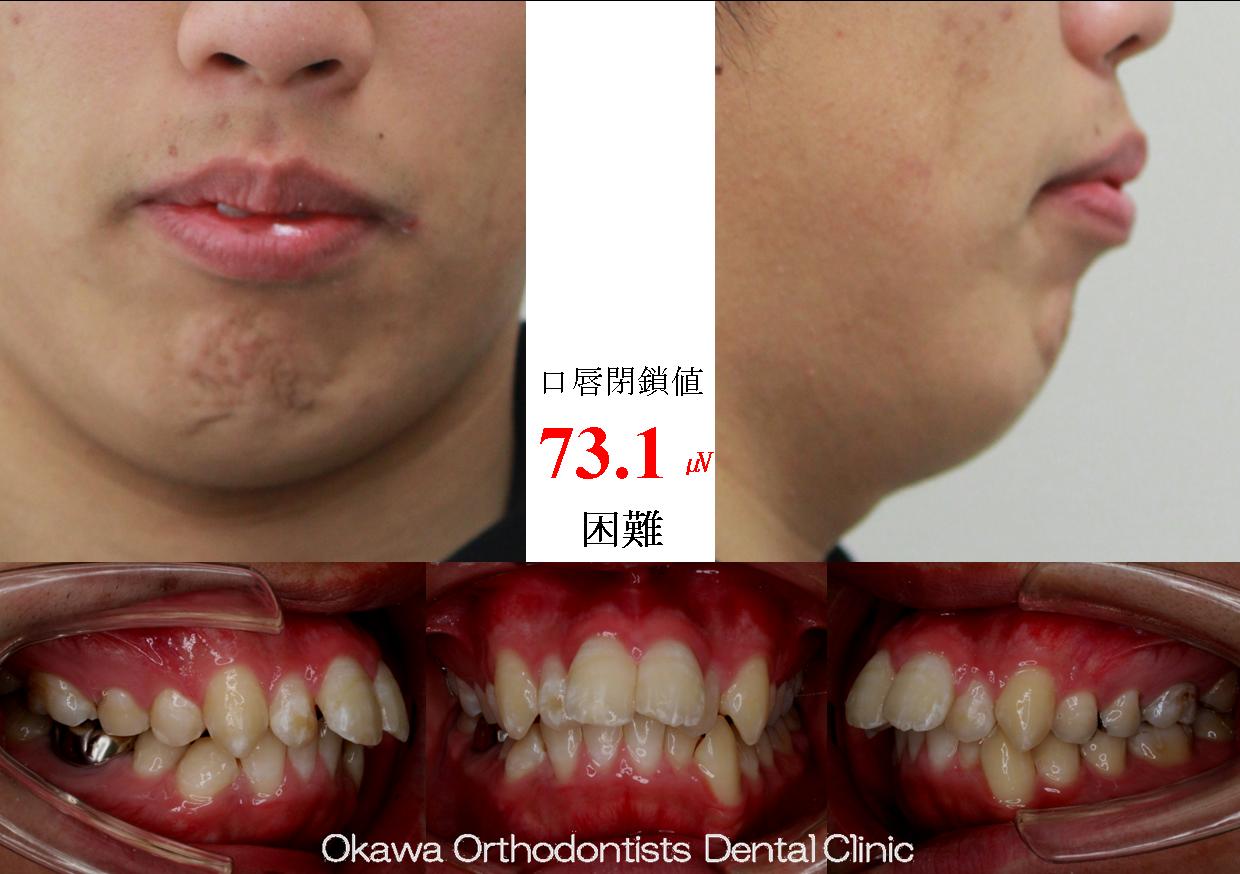 467. 口唇閉鎖不全が著しかったの Before 画像