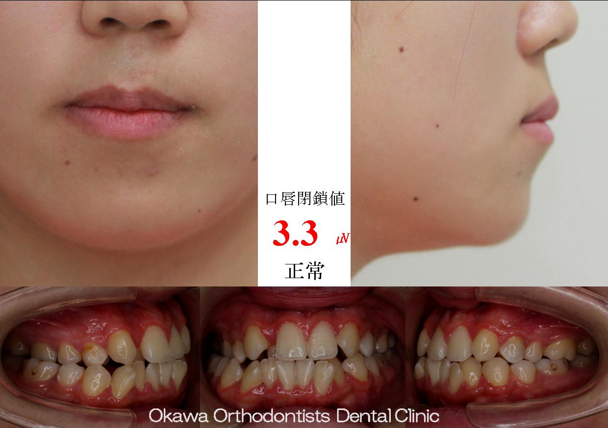 466. 左上側切歯抜歯の Before 画像