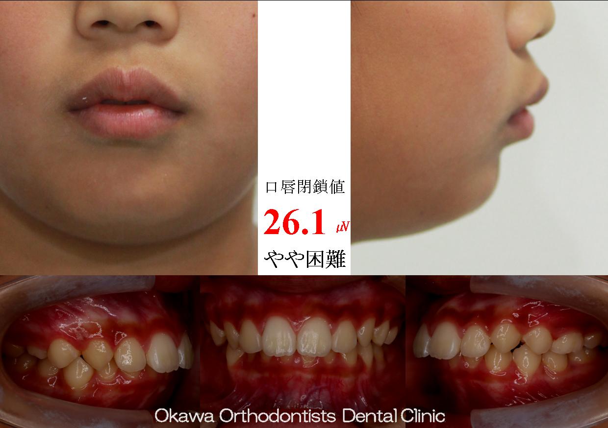 471. 抜くのがいやで非抜歯の Before 画像
