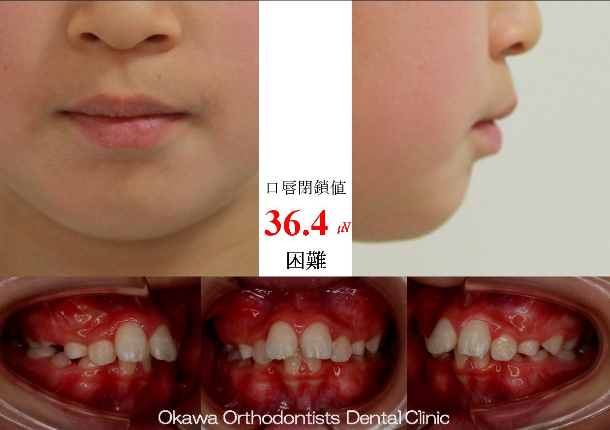 481. Ⅰ期治療で拡大、非抜歯での Before 画像