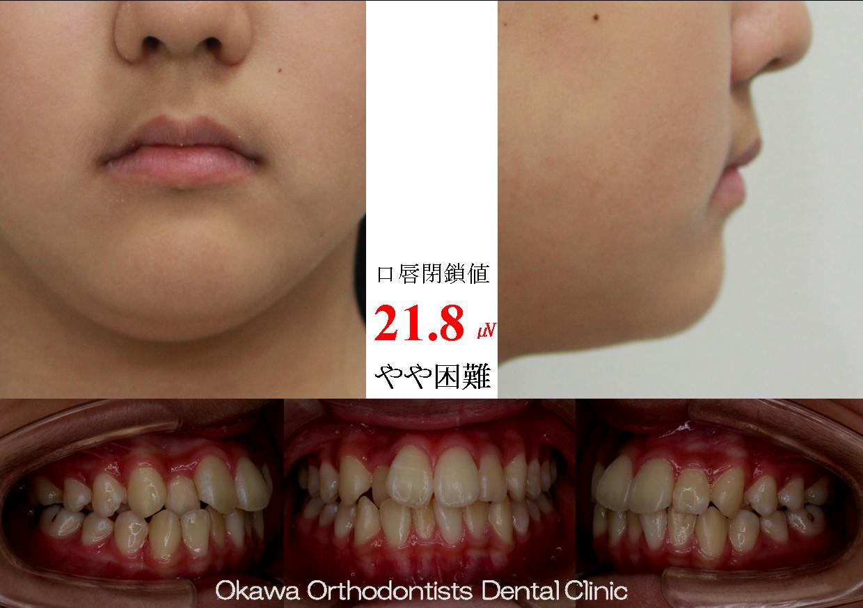 480. 軽度な叢生を非抜歯の Before 画像