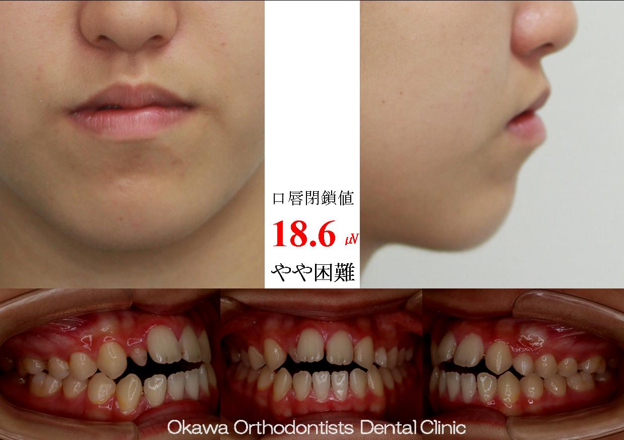 478. 上顎側切歯が先欠と矮小歯の Before 画像