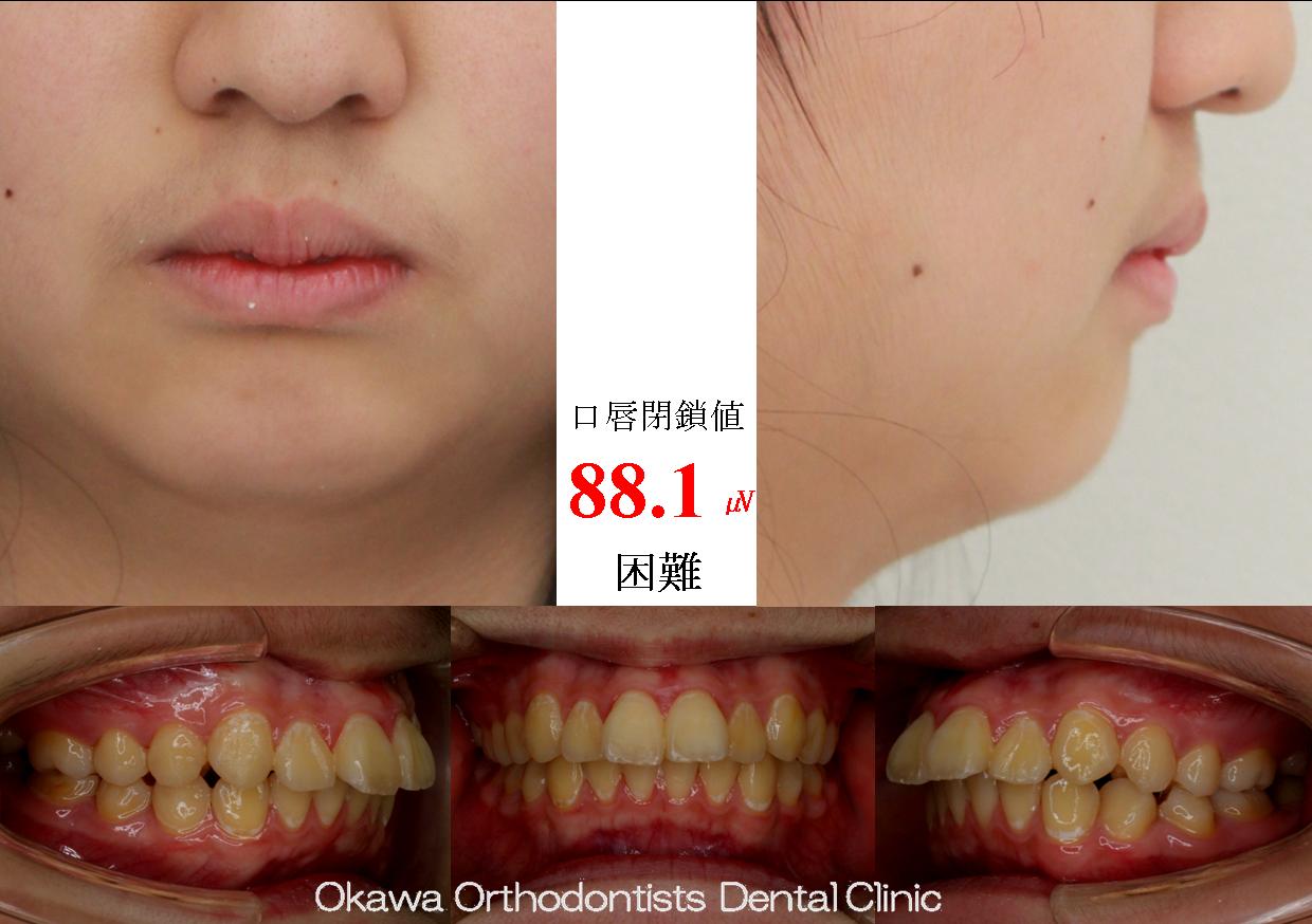 484. 上顎前突の抜歯症例の Before 画像