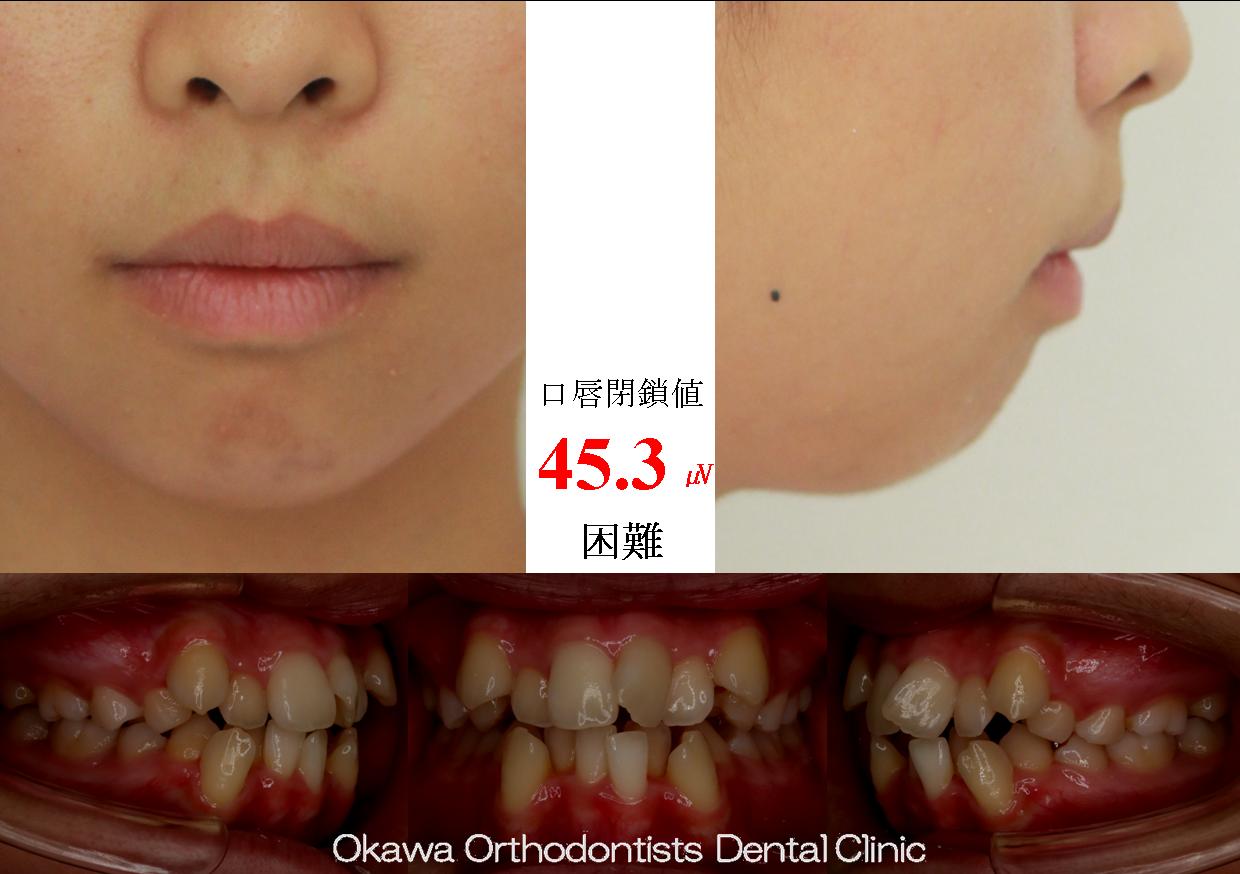 485. 口唇閉鎖がしにくい著しい叢生の Before 画像