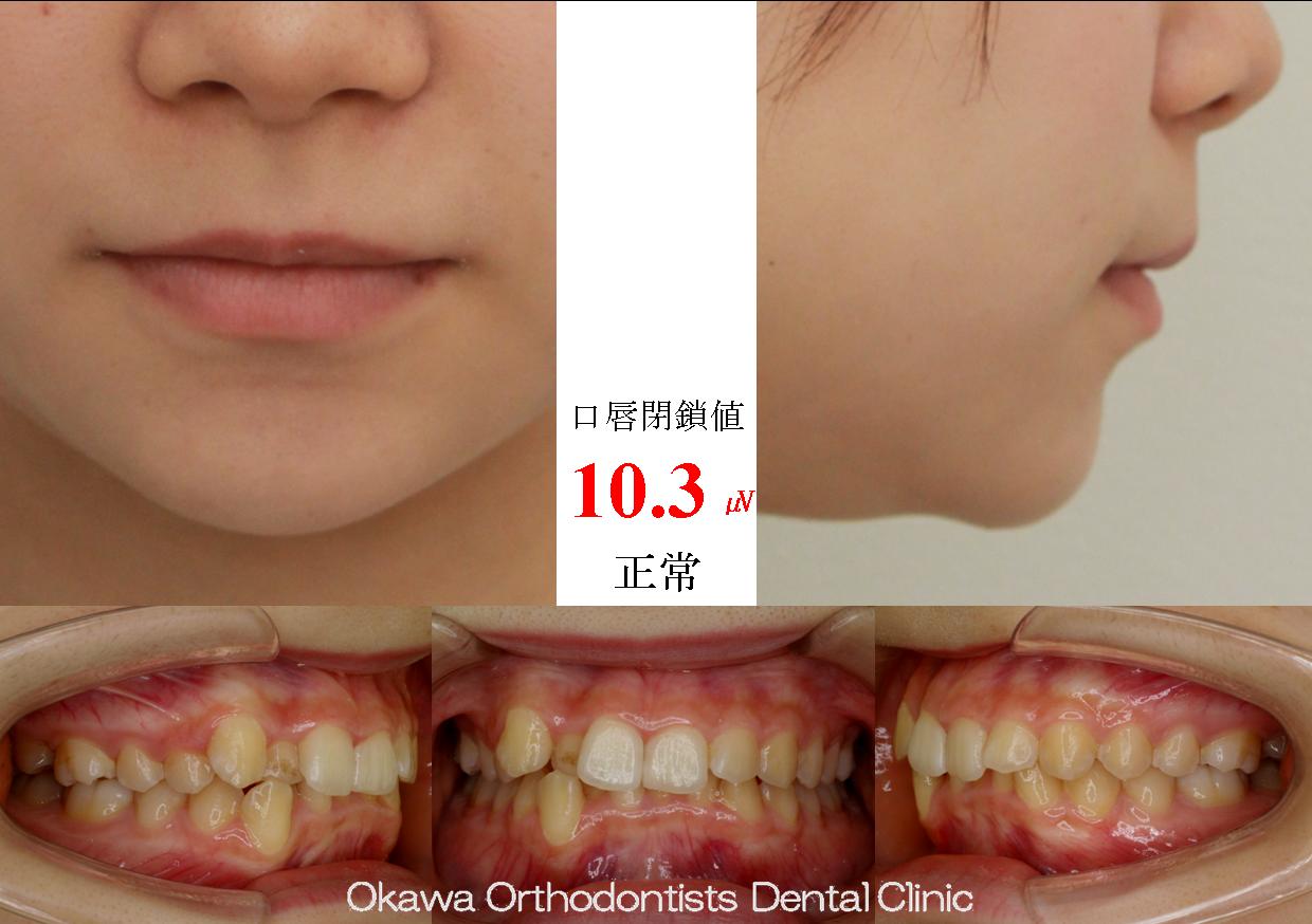 489. かみ合わせが深い叢生の Before 画像