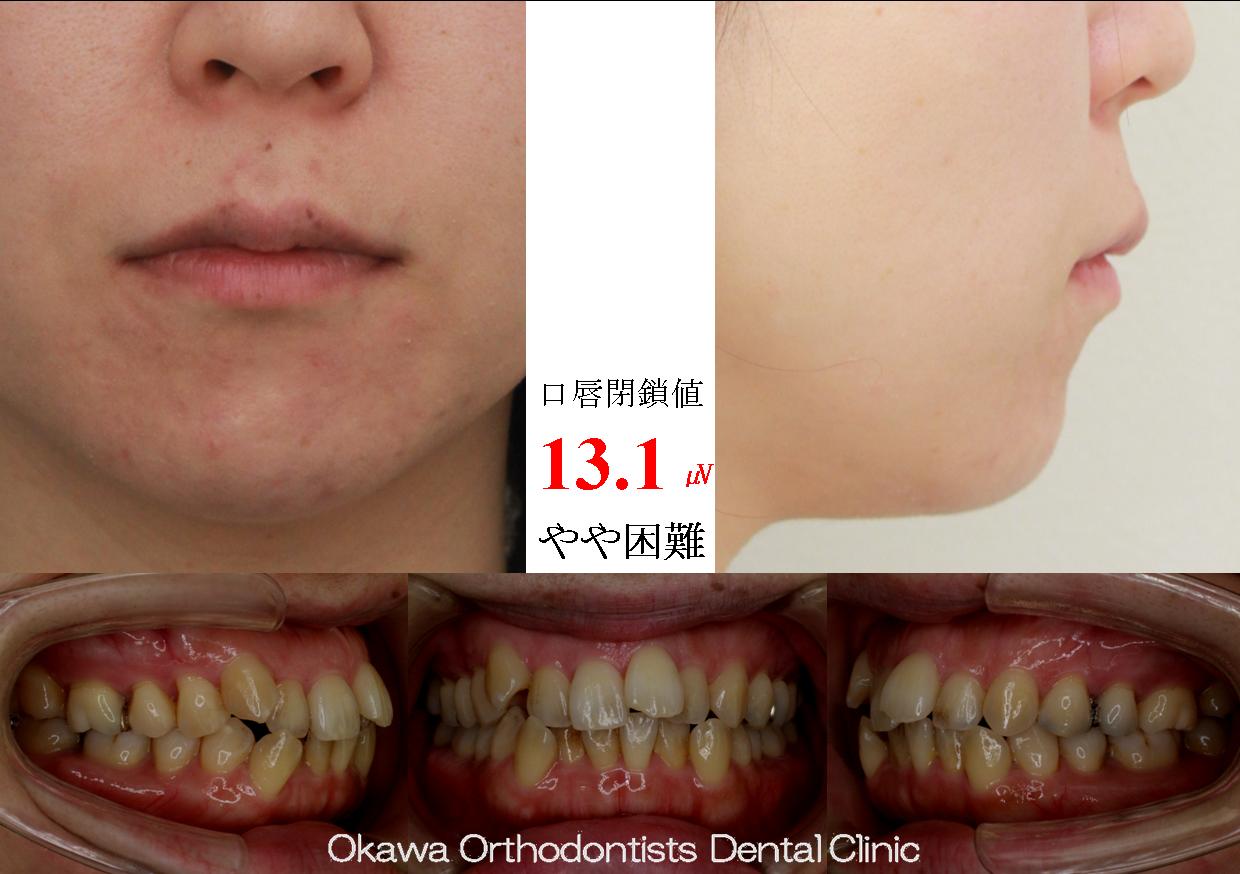 487. 上下顎左右側第2小臼歯抜歯の Before 画像