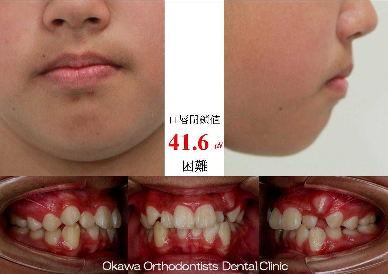 495. 初期になんども装置が壊れたの Before 画像