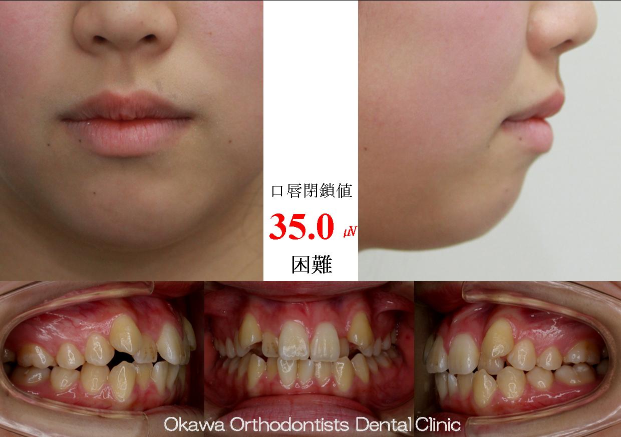 494. 意外に期間がかかった叢生の Before 画像