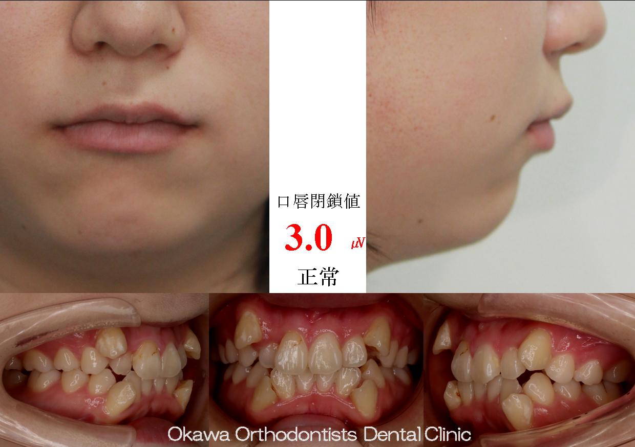 511. 叢生、八重歯の Before 画像