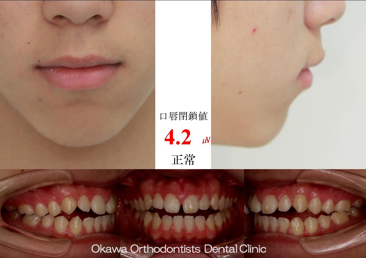 512. 軽度な開咬を非抜歯の Before 画像