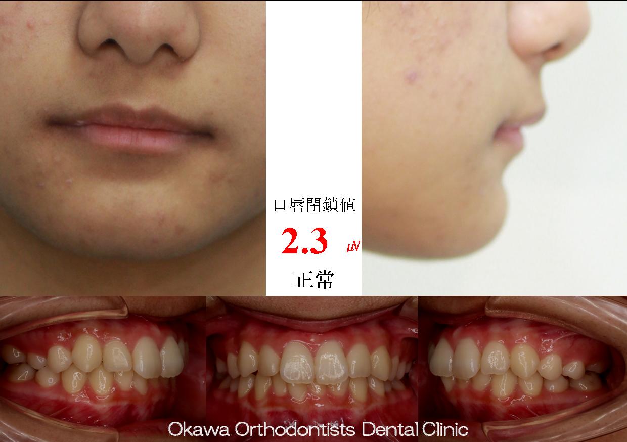 516. ややバイトが深い軽度叢生の Before 画像