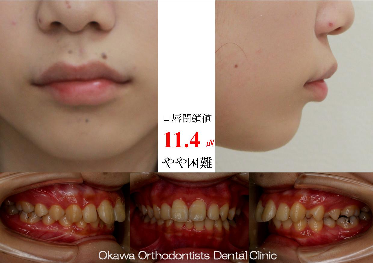 523. 咬合の仕上げに期間がかかったの Before 画像