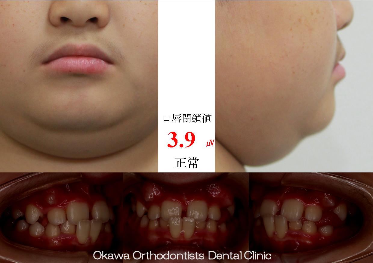 528. 反対咬合と叢生の Before 画像