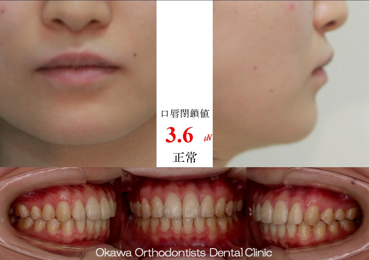529. 上下顎側方拡大で非抜歯の After 画像