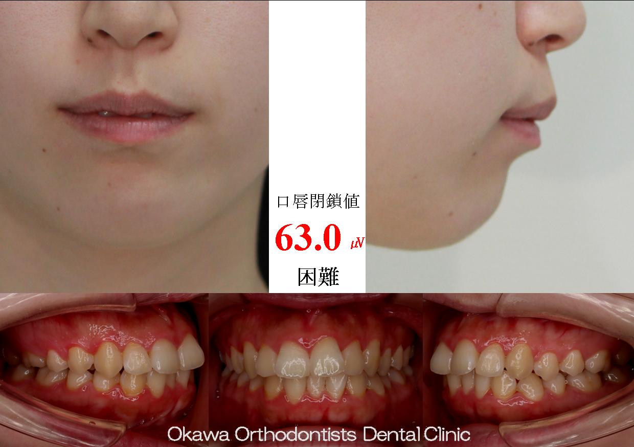 531. 下顎前歯抜歯の Before 画像