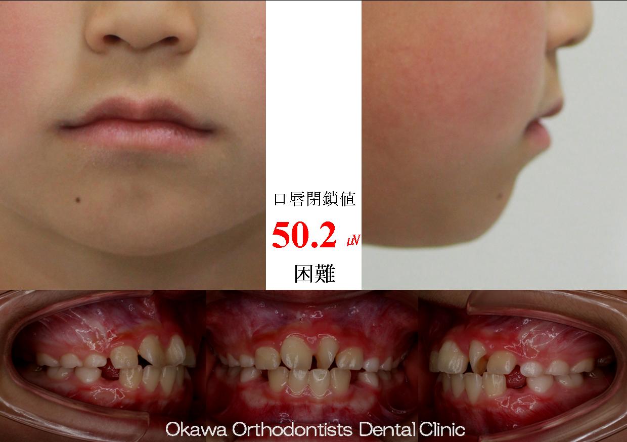 537. Ⅱ期では簡単な仕上げのみの Before 画像