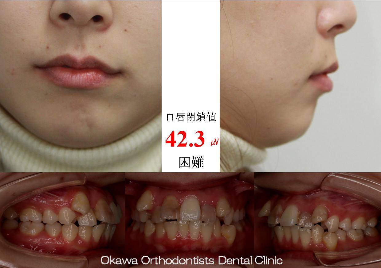542. 上顎前歯を抜歯の Before 画像