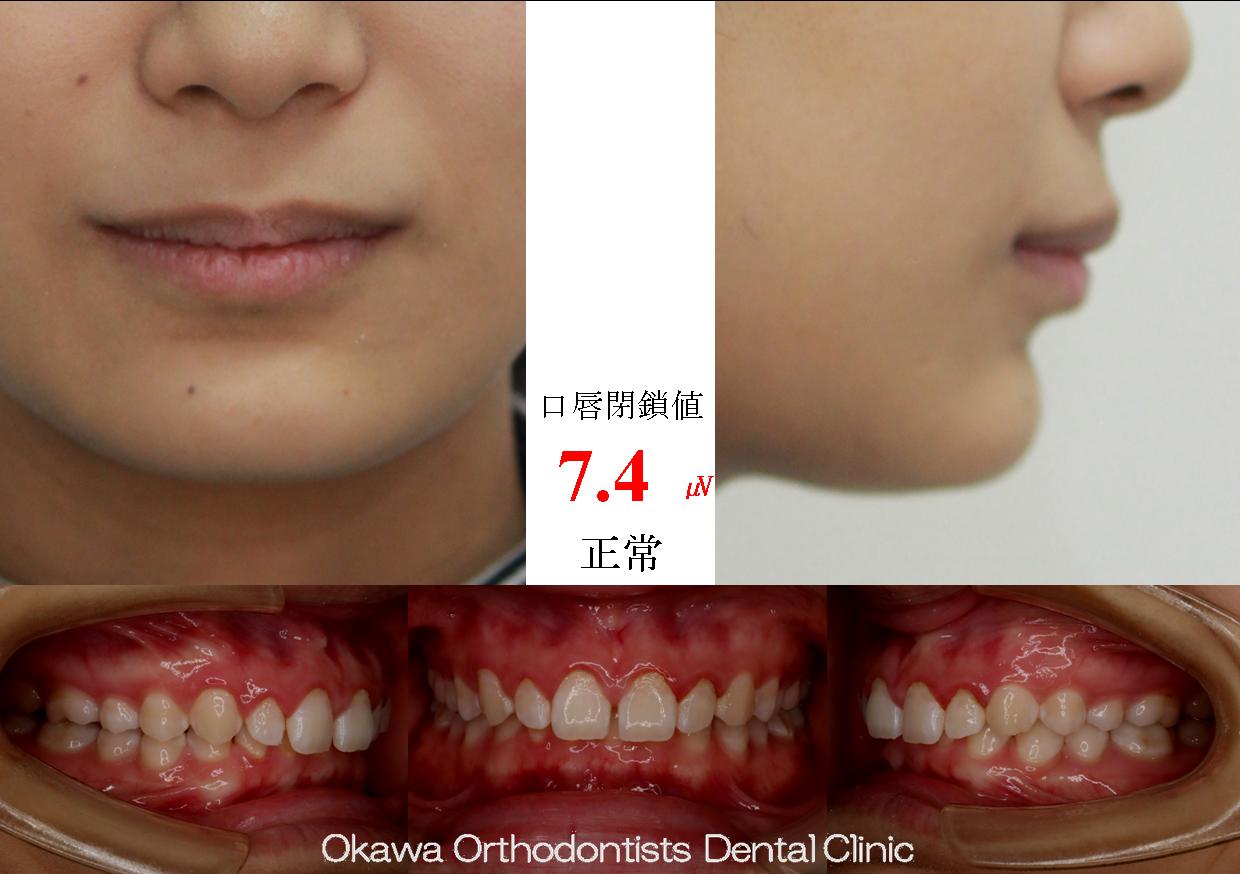 548. 正中が合わなかったの Before 画像